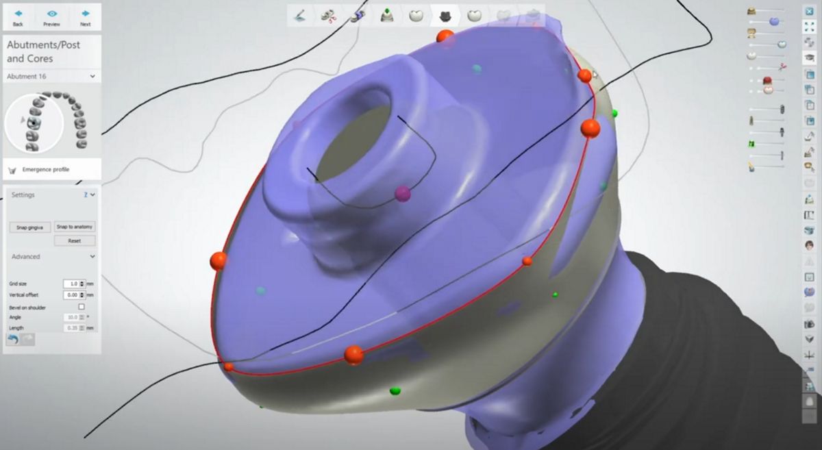 AHA workflow inside 3Shape Dental System CAD