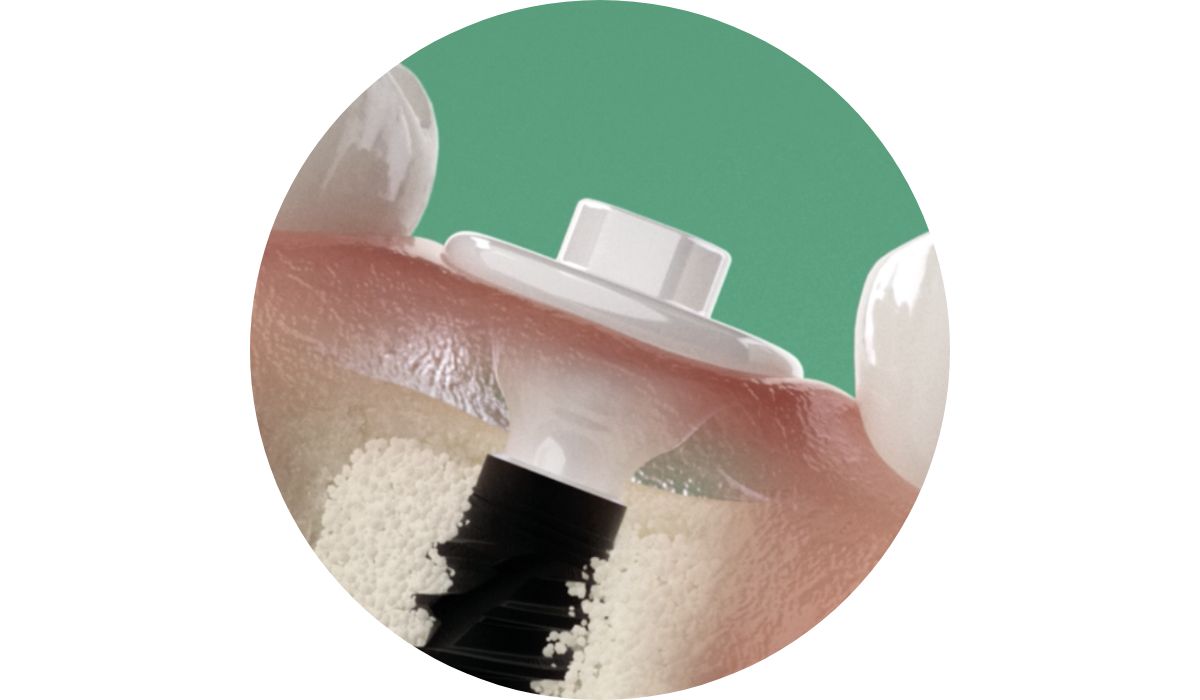 AHA seated at implant placement
