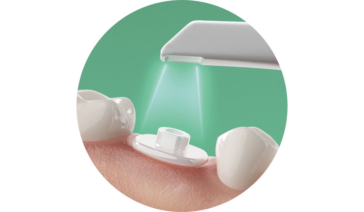 Intraoral scanning of the AHA in situ
